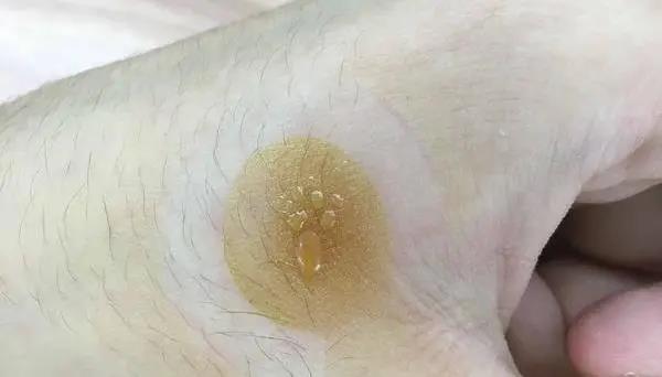 灸花，一種奇妙的花
