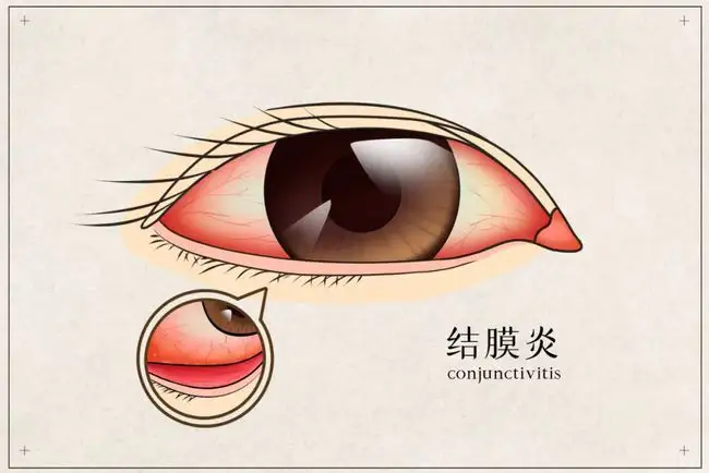 皮膚癢、拉肚子、腸胃不適、感冒，春夏換季病，艾灸來搞定！